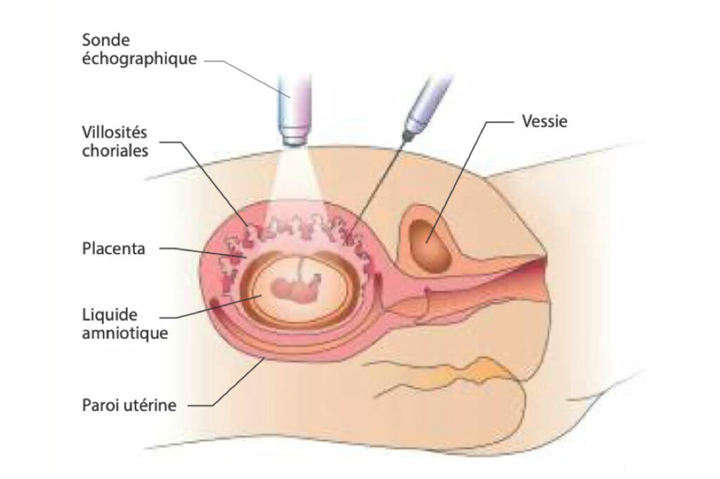 Schéma expliquant l'examen de la choriocentese par voie abdominale