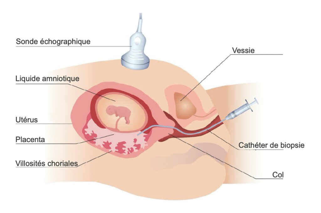Schéma expliquant l'examen de la choriocentese par voie transcervicale