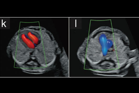 Coeur foetal au 1er trimestre