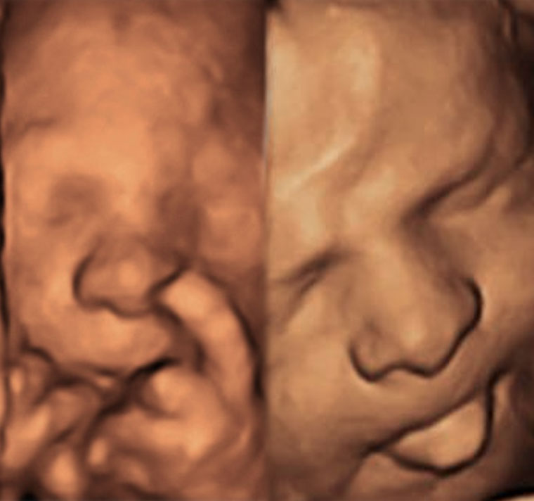 Visage 3D d'un foetus