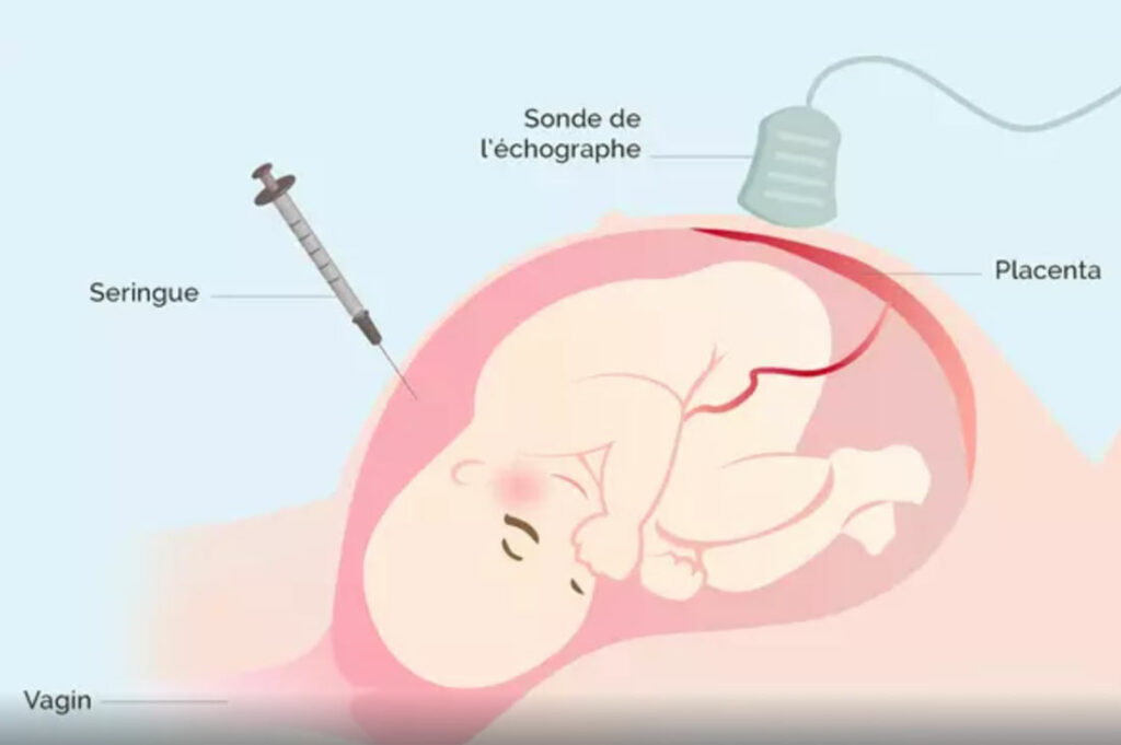 Schéma expliquant l'examen de l'amniocentese