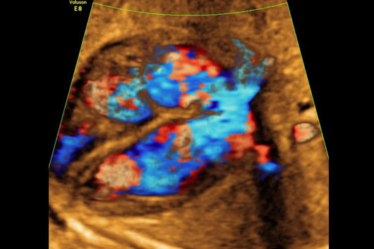 Échographie du coeur foetal au 2ème trimestre