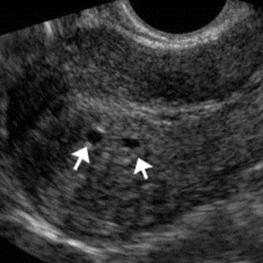 Adénomyose : endométriose interne à l’utérus