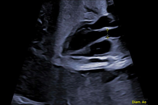 Échographie du coeur foetal au 3ème trimestre