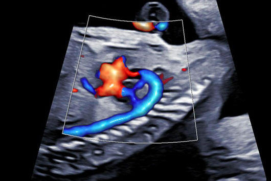 Échographie du coeur foetal au 2ème trimestre