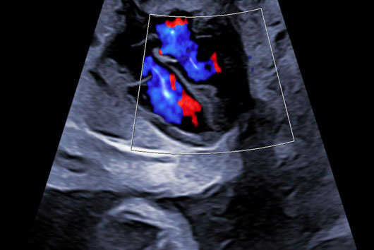 Échographie du coeur foetal au 3ème trimestre