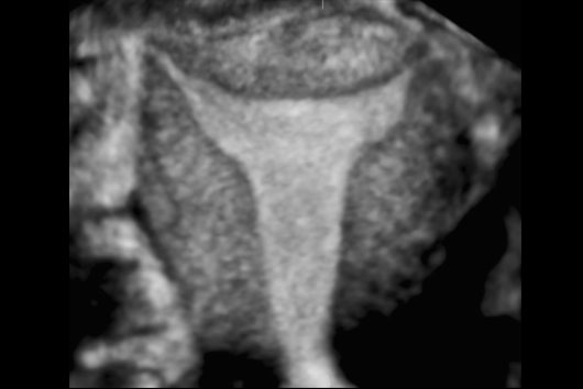 Échographie d'un utérus normal