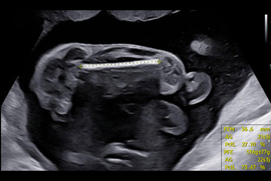 Échographie du fémur au 2ème trimestre