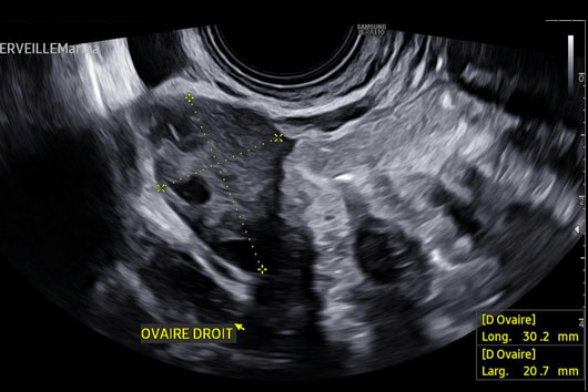 Échographie en 2D d'un ovaire normal