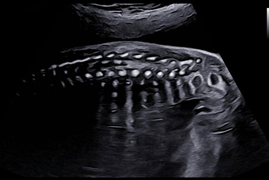 Échographie du rachis au 2ème trimestre