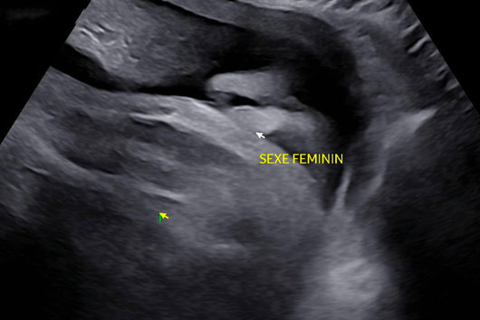 Échographie du sexe féminin au 3ème trimestre