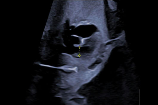 Échographie du coeur foetal au 3ème trimestre