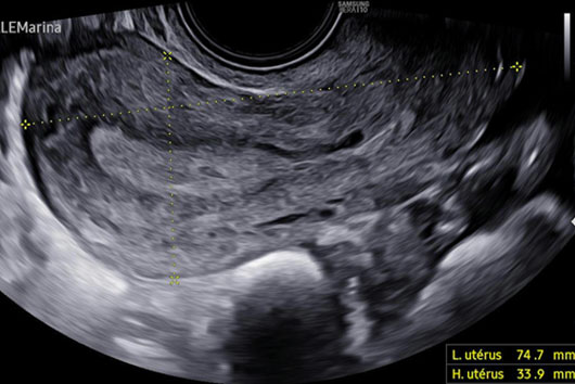 Échographie d'un utérus normal
